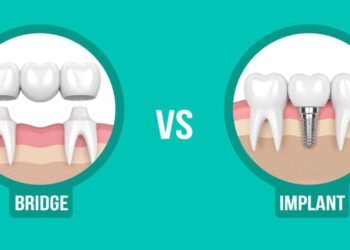 Tooth Implant vs Dental Bridge: Which is Better?