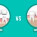 Tooth Implant vs Dental Bridge: Which is Better?